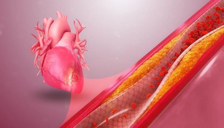 ИБС – патология острой или хронической формы, вызванное нарушением кровотока в сердечную мышечную ткань.