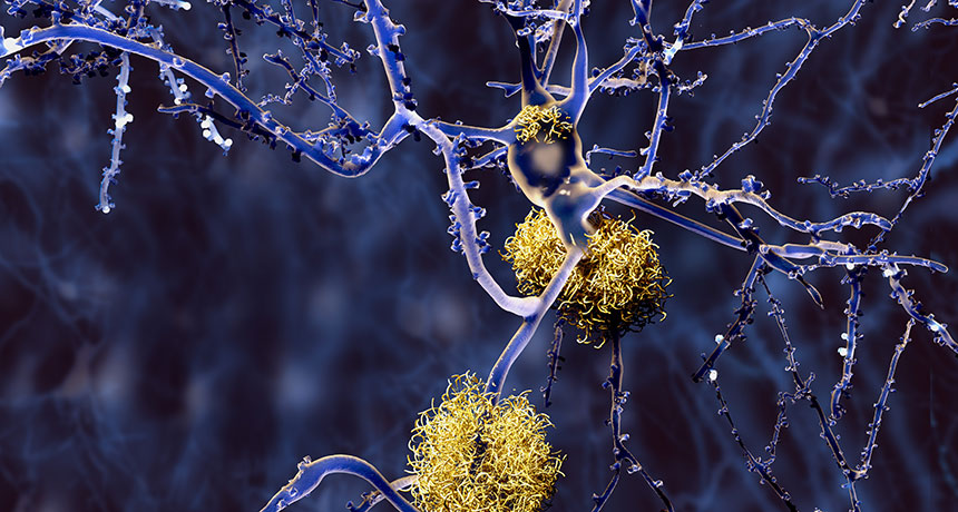 Медики СПбГУ нашли новые потенциальные биомаркеры болезни Альцгеймера