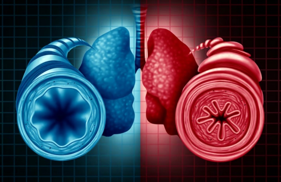 Прорыв в лечении астмы раскрывает ключевой механизм утолщения дыхательных путей