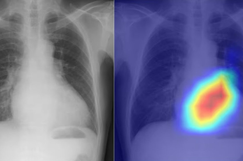 ИИ превращает скромный рентген грудной клетки в лучший диагностический инструмент